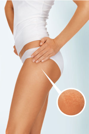 Unterstützung bei Cellulite (Orangenhaut)